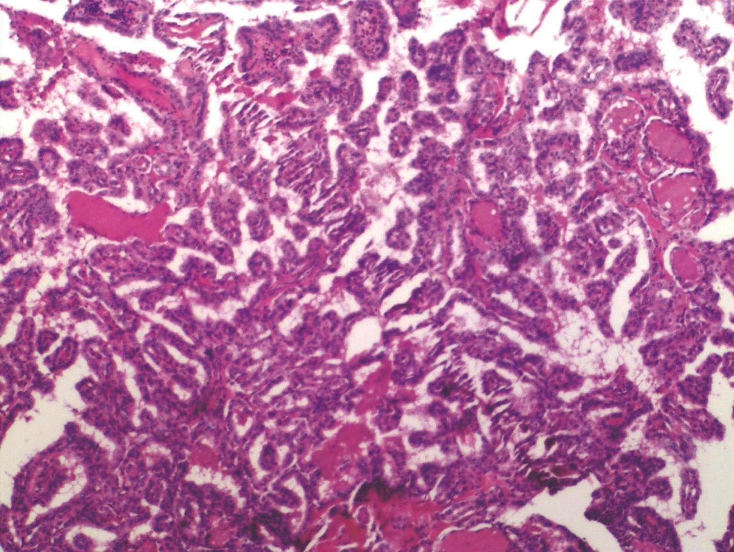 /uploads/image/2025-05-26/163243833图12 术后病理切片.jpg 图12 术后病理切片